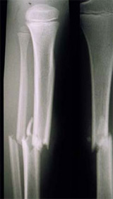 Röntgenbild einer Unterschenkelfraktur - 1