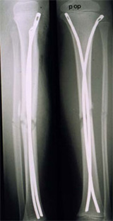Röntgenbild einer Unterschenkelfraktur - 2