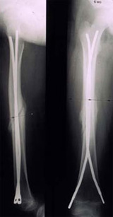 Röntgenbild einer Oberschenkelfraktur