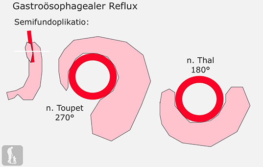 Gastroösophagealer Reflux - 03