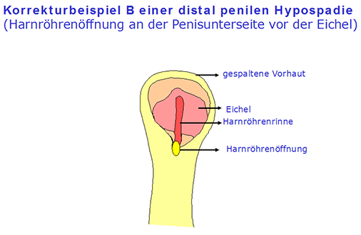 Hypospadie - Beispiele von Korrekturoperationen