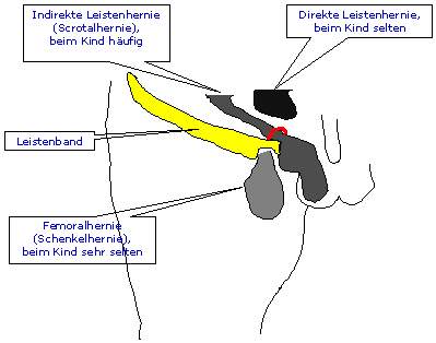 Inguinalhernie (Leistenbruch) und Hydrocele - 01