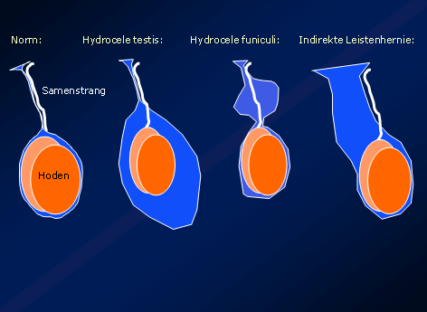 Inguinalhernie (Leistenbruch) und Hydrocele - 02