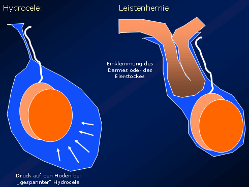 Groin hernias (Inguinal hernias) - 01