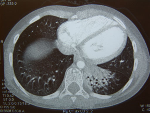 Bronchiectasis