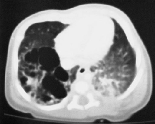 Congenital cystic adenomatoid malformation