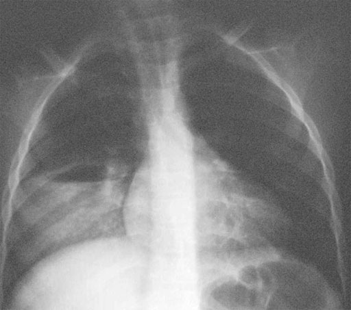 Lung abscess