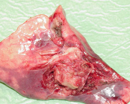 Inflammatory pseudo-tumor surrounding the main bronchus