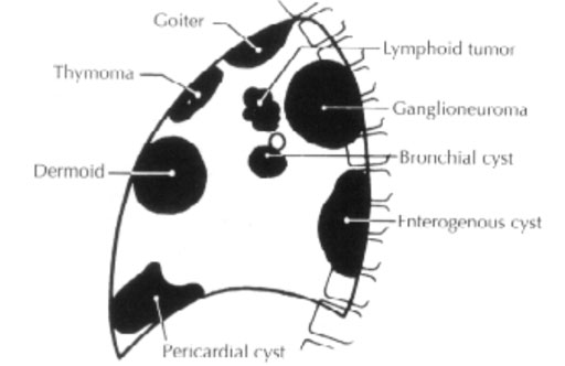 Mediastinal masses (Carachi R. Et. al.: The Surgery of Childhood Tumors)