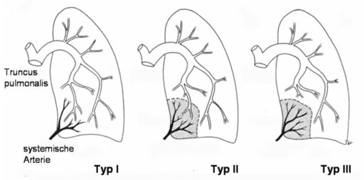 Intralobar sequestrations; Pryce classification (Bettex M. et. al. : Kinderchirurgie, Thieme 1982)
