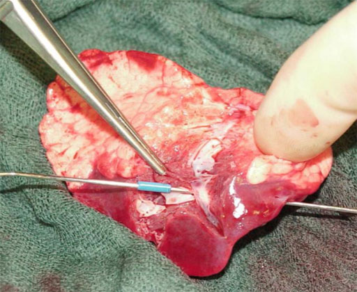 Type II of intralobar sequestration (surgically opened large arterial vessels)