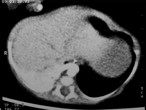 Abnormal arterial blood supply of the sequestration