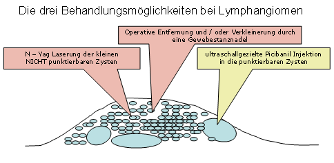 Lymphangiom / Hygrom - 04
