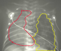 Die gelbe Linie umrahmt die in den Brustkorb verlagerten Darmschlingen